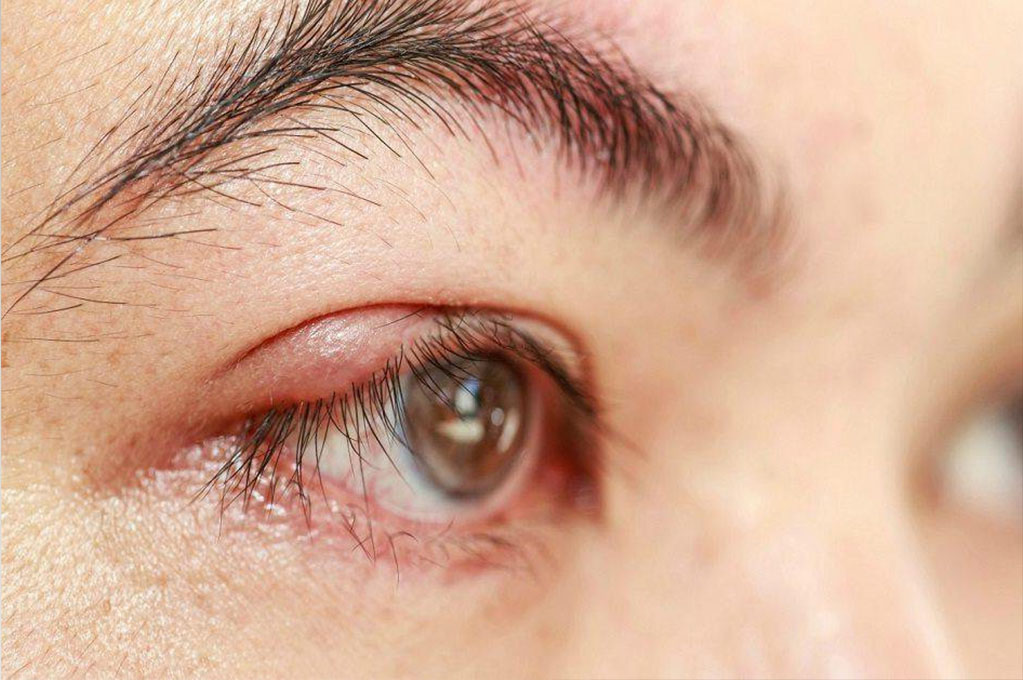 Pandemia aumenta casos de terçol